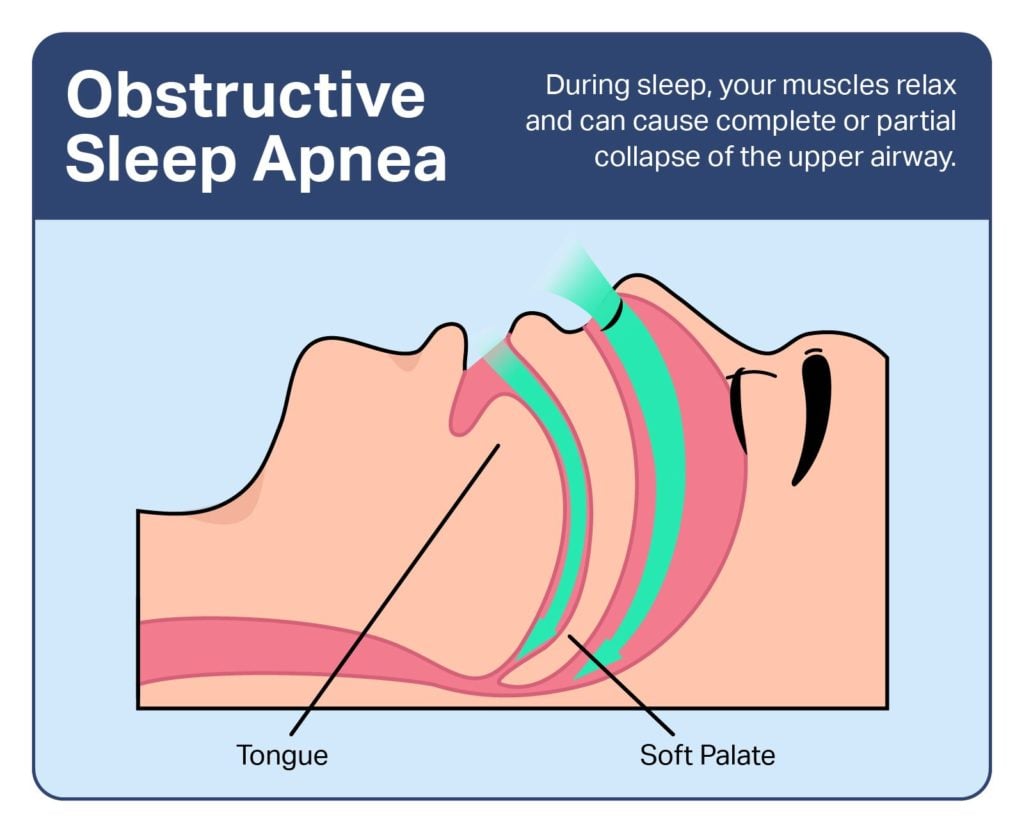 Apnea obstructiva del sueño