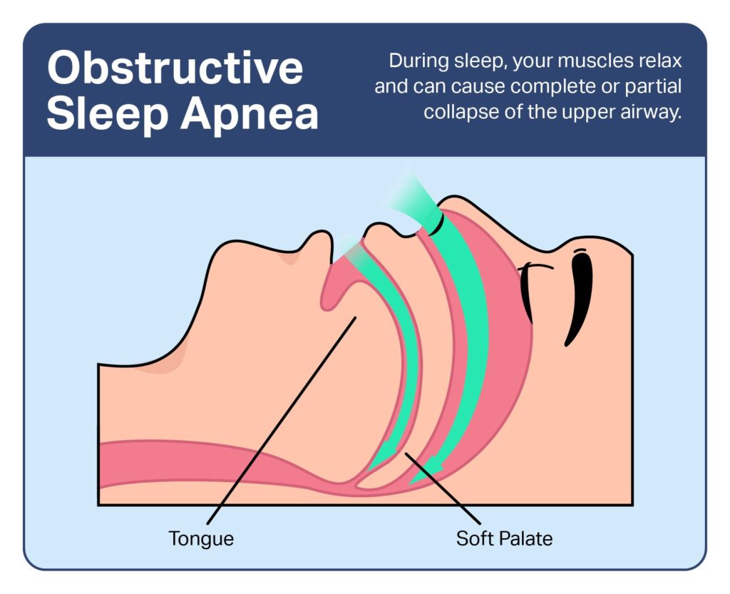 Sleep Apnea Symptoms, Testing & Treatment