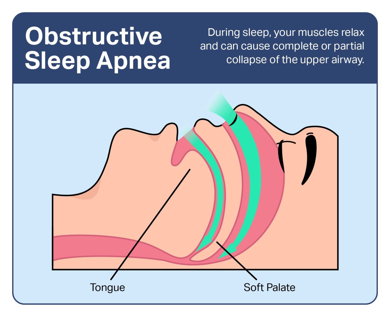 Obstructive Sleep Apnea Symptoms Causes And Treatments Sleep Foundation