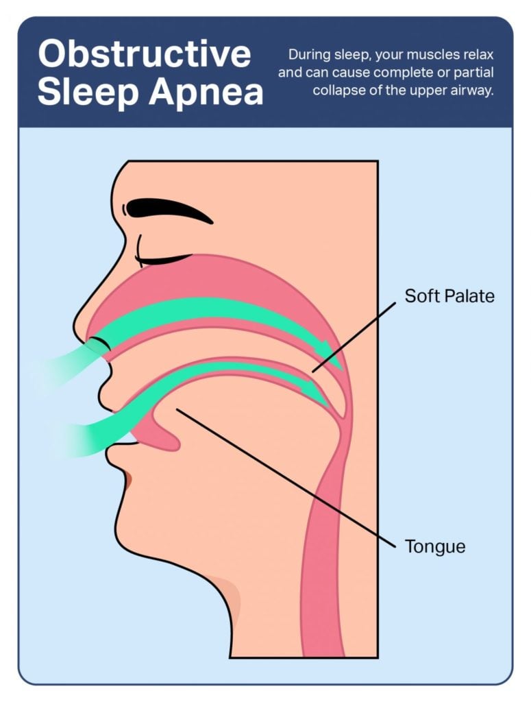 Infographic explaining obstruction to the airway caused by the tongue and soft palate.