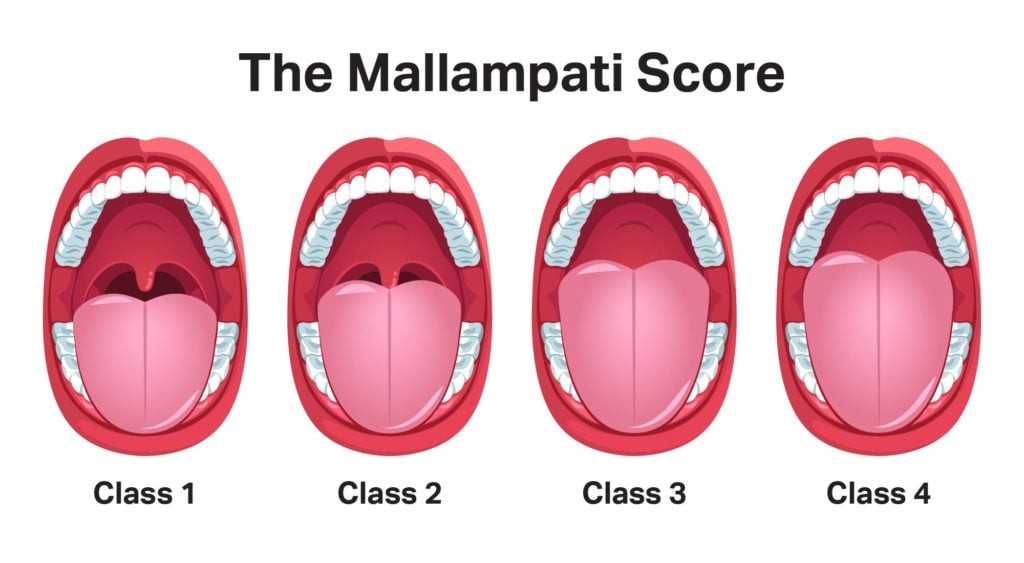 Infographic showing how tongue size determines Mallampati Score.