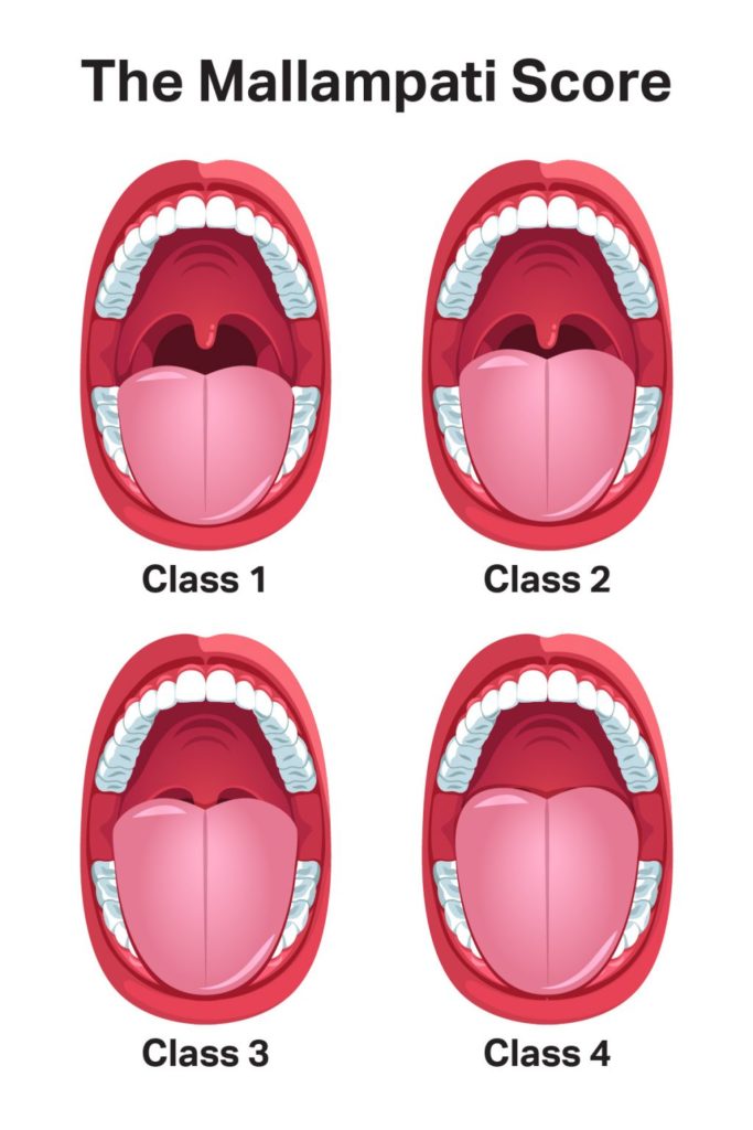 Infographic showing how tongue size determines Mallampati Score.