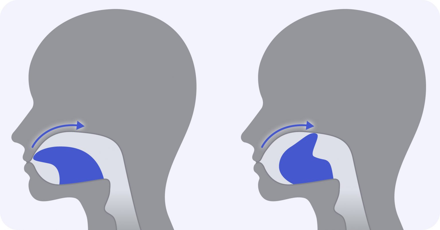 Diagram illustrating the tongue slide mouth exercise