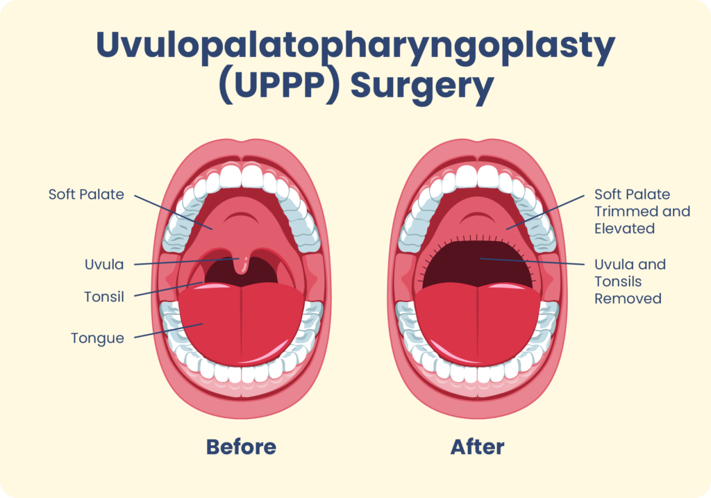Graphic showing how UPPP surgery trims and elevates the soft palate and removes the uvula and tonsils. 